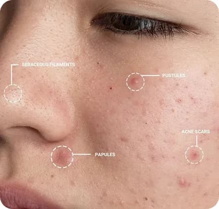 Close-up face photo with annotation markers for sebaceous filaments, pustules, papules, and acne scars